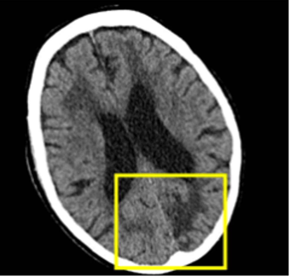 Confusion in Acute Occipital Infarcts: Why Blame Delirium?