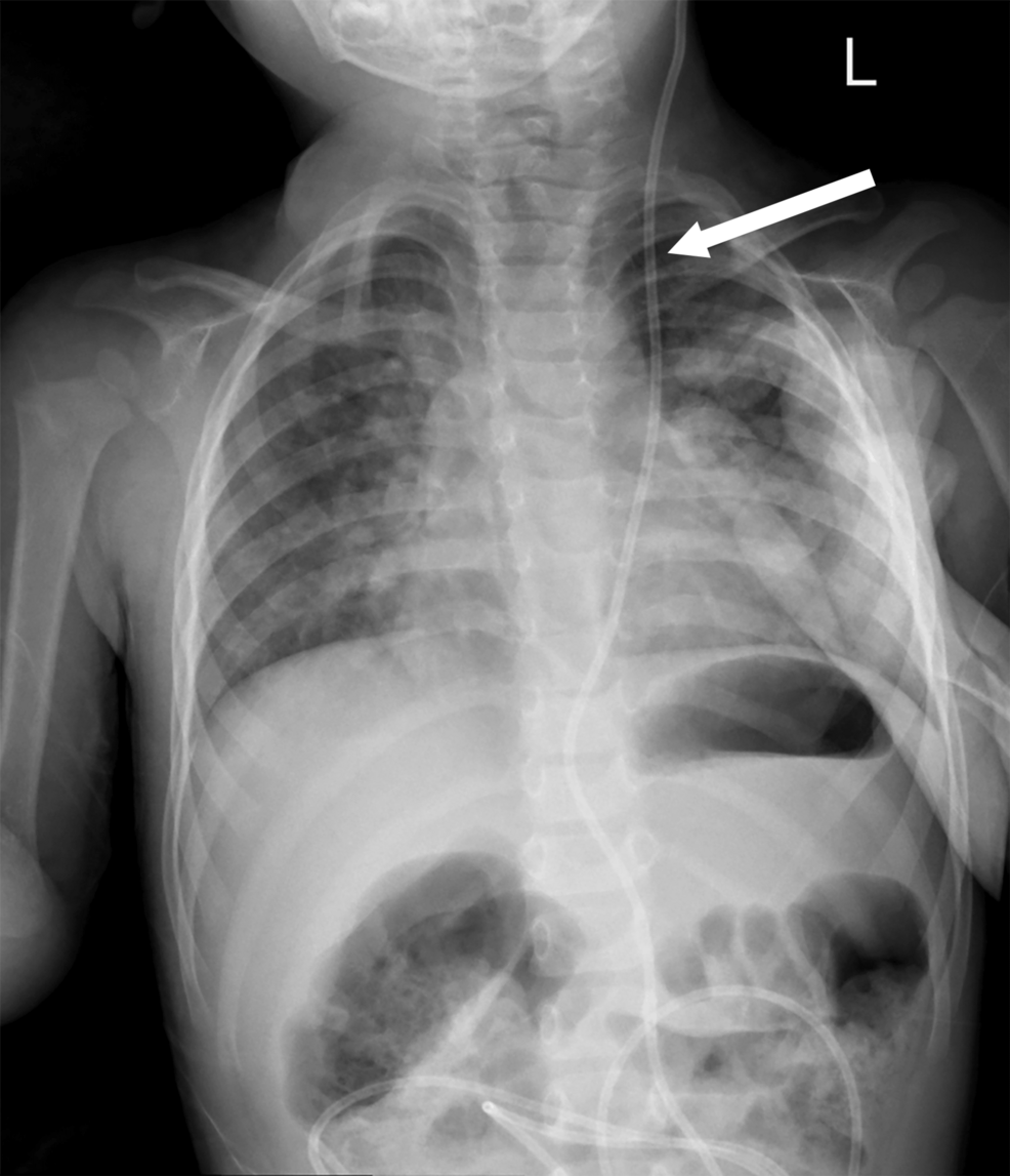 Preoperative-chest-X-ray-with-left-sided-ventriculoperitoneal-shunt-tubing-(white-arrow).