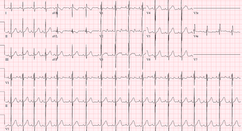 Preoperative-electrocardiogram-(ECG).