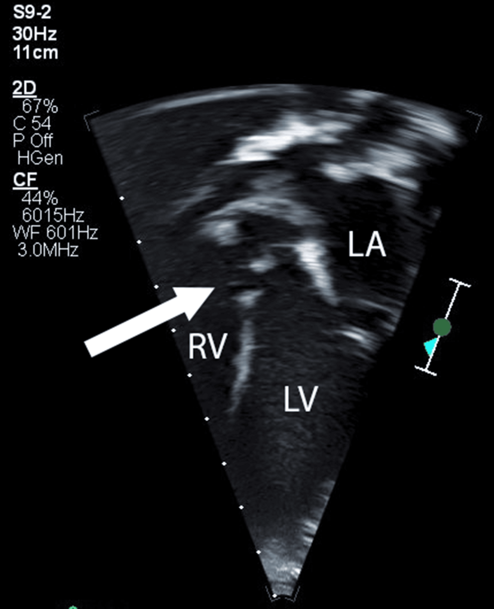 Preoperative-transthoracic-echocardiogram-(apical-five-chamber-view)-showing-ventricular-septal-defect-(white-arrow).