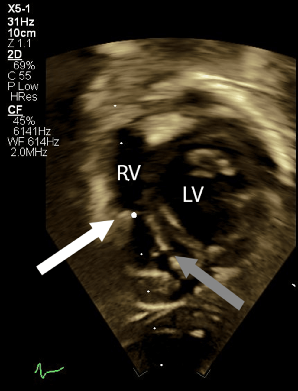 Preoperative-transthoracic-echocardiogram,-subcostal-view,-showing-double-chamber-right-ventricle-(white-arrow)-and-ventricular-septal-defect-(gray-arrow).
