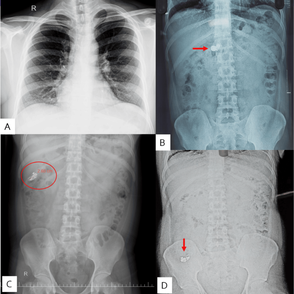 An Unusual Pairing in the Gut: Accidental Ingestion of a Wireless Earbud in an Adult