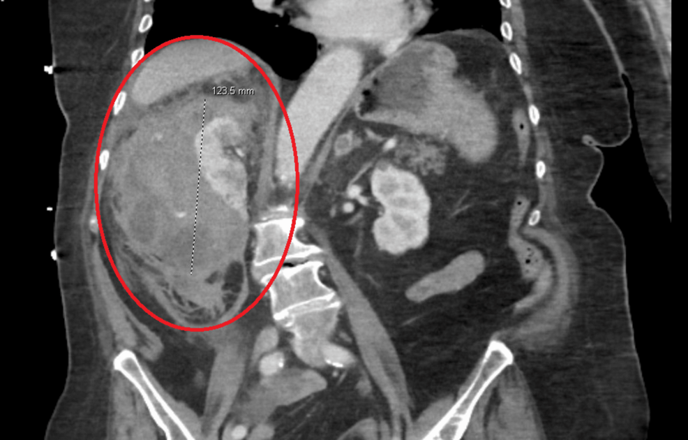 Spontaneous Renal Hemorrhage in an Anticoagulated Patient With Prior Large-Vessel Vasculitis: A Wonder of Its Own