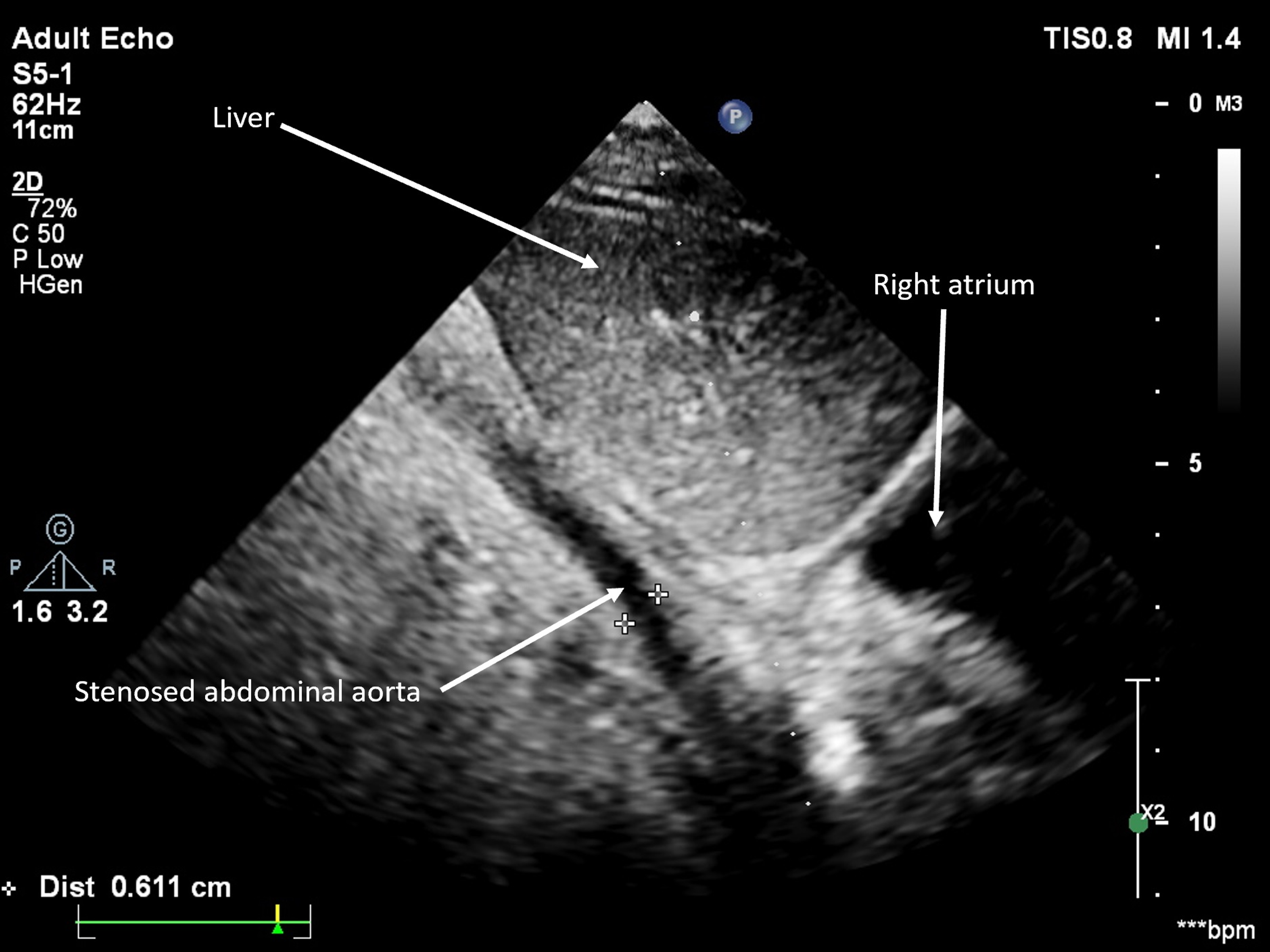Collecting leaves Laptop Postage Cureus | The Role of Echocardiography in Evaluation of Takayasu's  Arteritis: A Report of Two Cases | Article