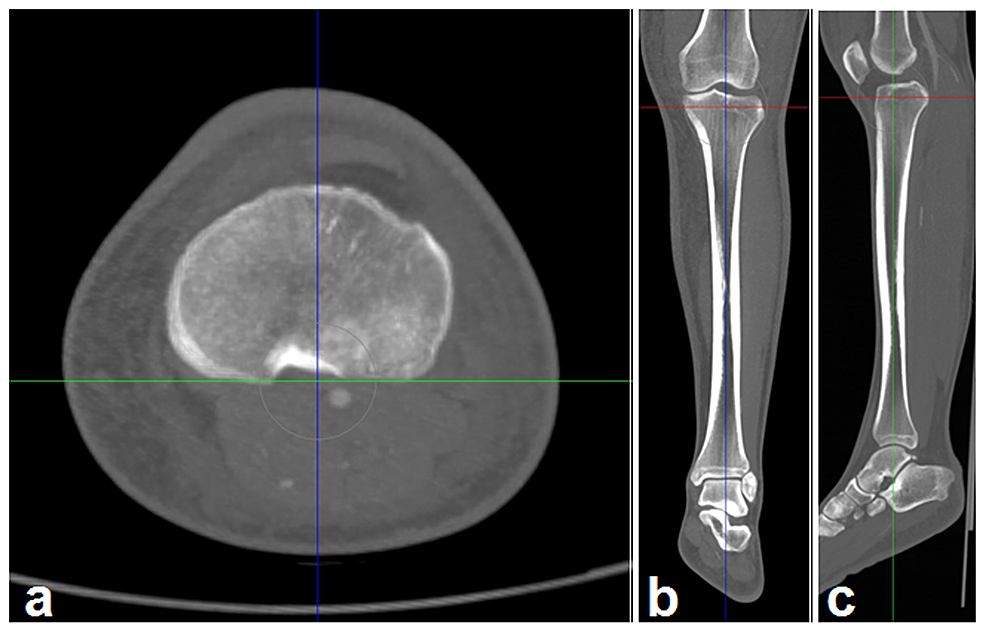 MPR Knee Bolster - MPR Orthopedics
