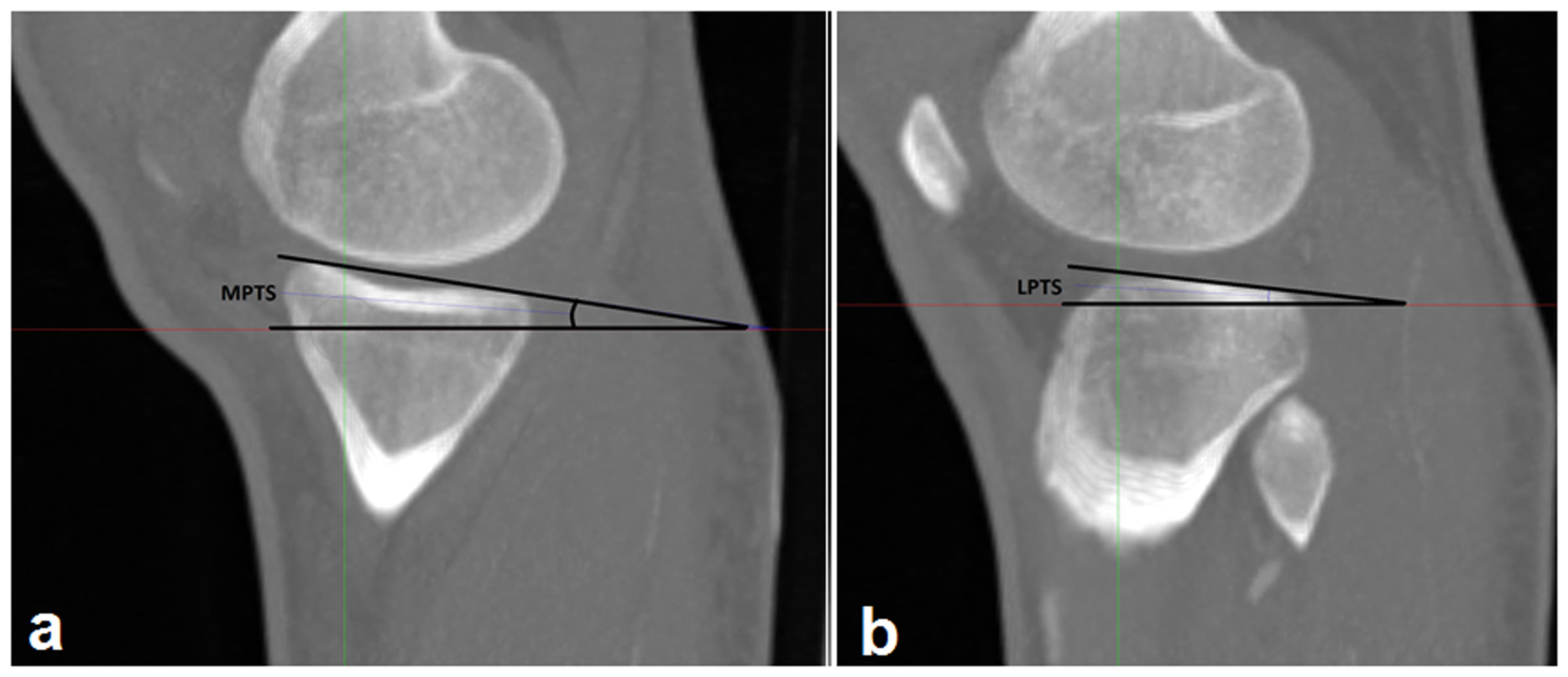 Cureus | Posterior Tibial Slope and a New Morphometric Method With ...