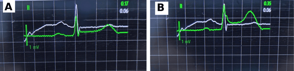 -Dynamic-intraoperative-ST-segment-elevation-before-hemodynamic-collapse