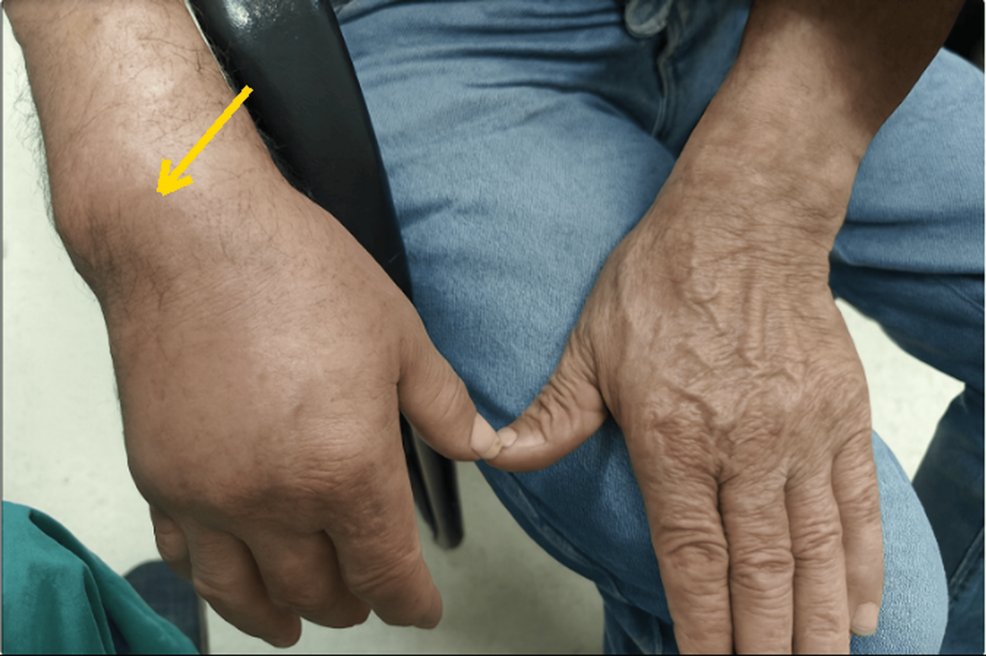 Right-wrist-at-presentation-(D1):-swelling-and-erythema-(arrow)-compared-with-the-contralateral-wrist