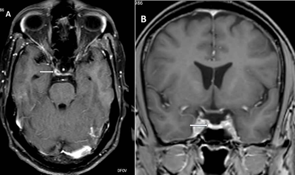 Contrast-enhanced-MRI-demonstrating-right-cavernous-sinus-orbital-apex-enhancement