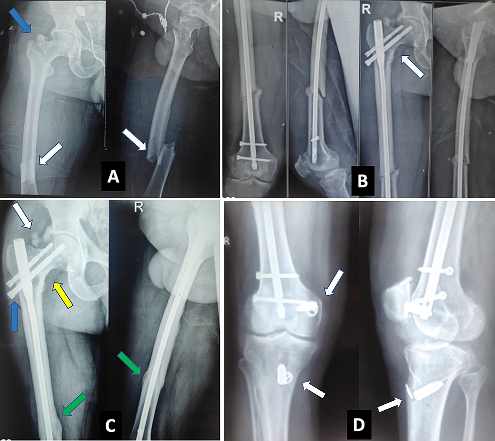 Shortening/re-lengthening and nailing versus bone transport for the  treatment of segmental femoral bone defects | Scientific Reports