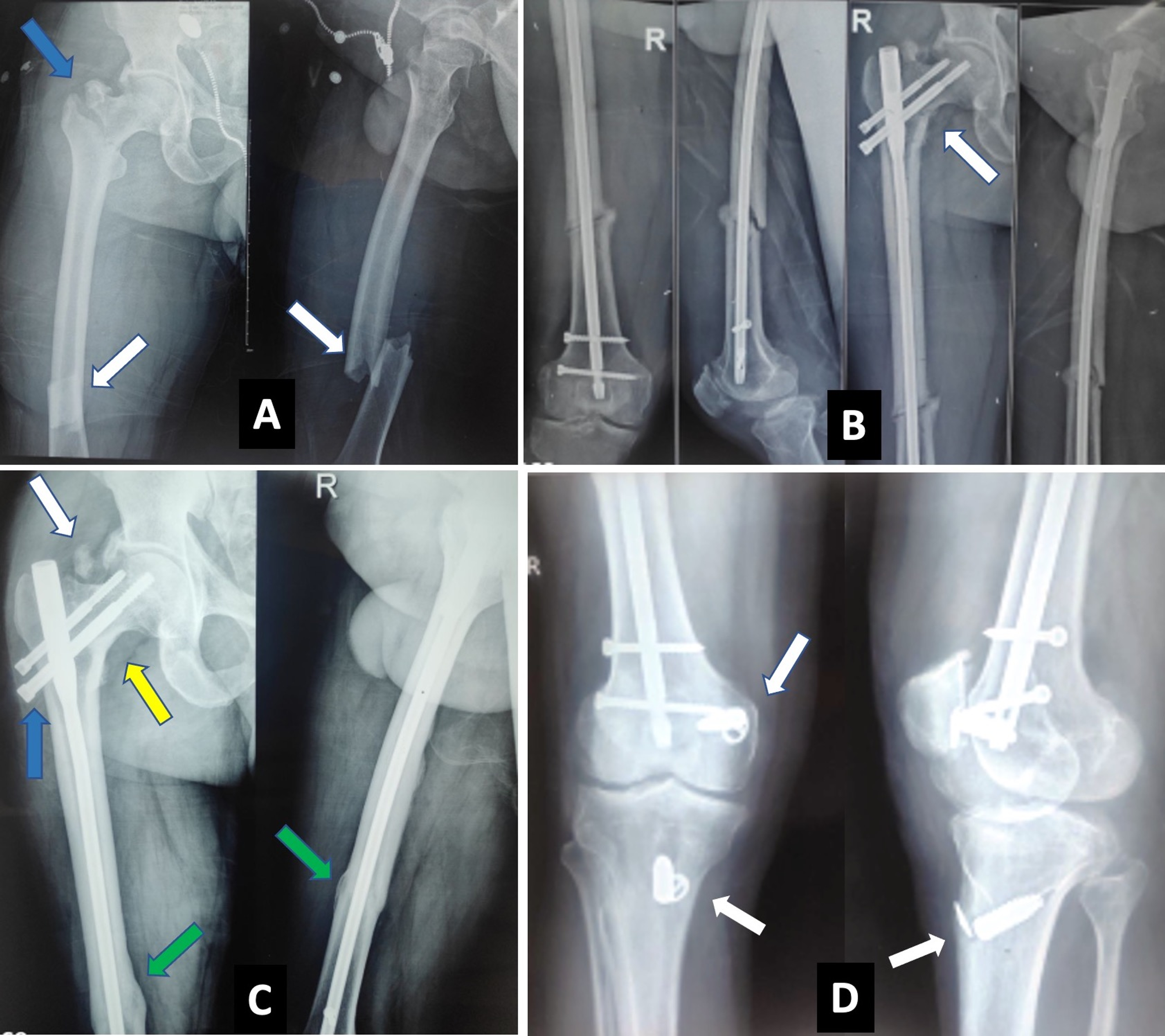 Cureus | Clinicoradiological Outcome of Concomitant Fractures of Proximal  Femur and Femoral Shaft Treated With Second-Generation Cephalomedullary  Nailing | Article
