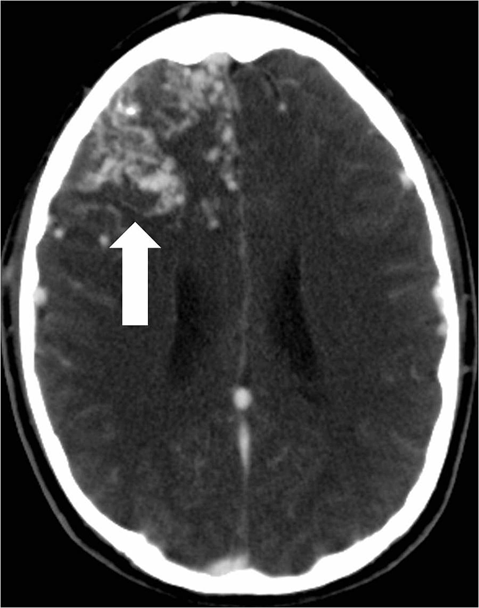 Computed-tomography-angiogram-of-the-head-shows-the-large-enhancing-right-frontal-lobe-arteriovenous-malformation-nidus-(arrow).