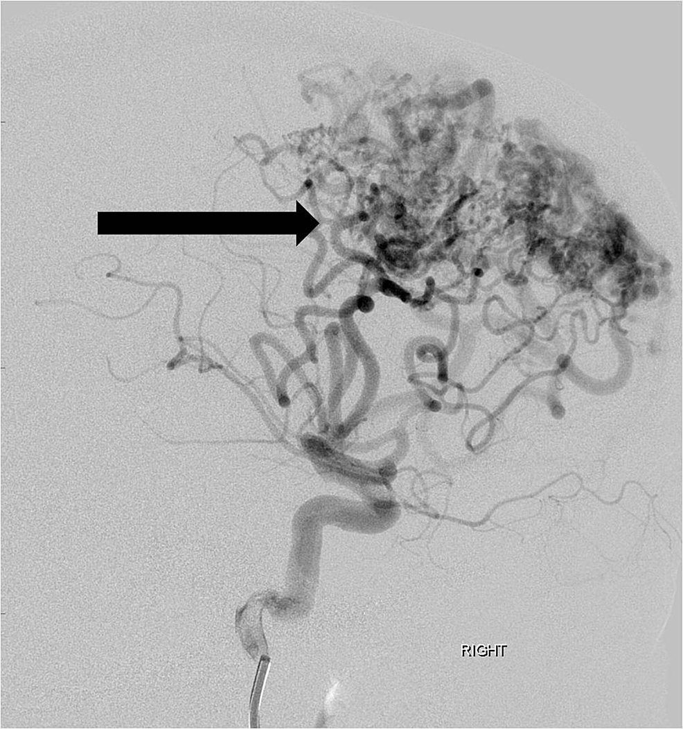 Lateral-projection-angiographic-image-from-a-right-internal-carotid-artery-injection-shows-a-large-arteriovenous-malformation-nidus-(arrow)-fed-by-multiple-enlarged-feeding-anterior-and-middle-cerebral-artery-branches.