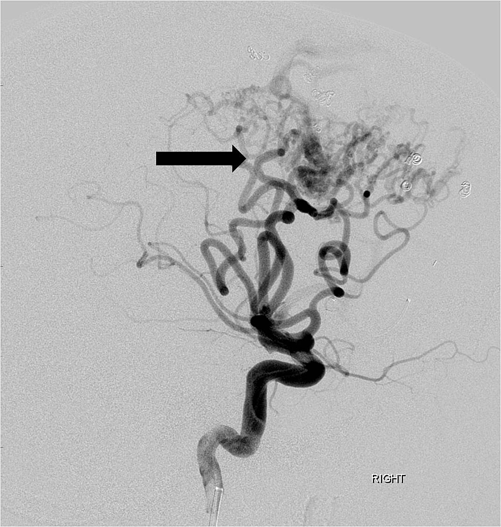 Following-embolization-of-multiple-anterior-cerebral-artery-feeding-branches-with-particles,-gel-foam-and-coils,-there-is-marked-reduction-in-size-and-flow-dynamics-of-the-arteriovenous-malformation-(arrow).