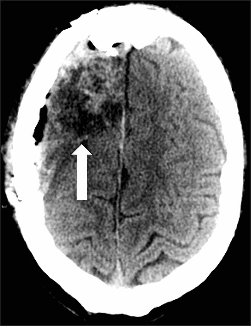 Head-computed-tomography-on-postoperative-day-three-reveals-expected-changes-of-a-right-frontoparietal-craniotomy-with-a-resection-cavity-in-the-right-frontal-lobe-(arrow).