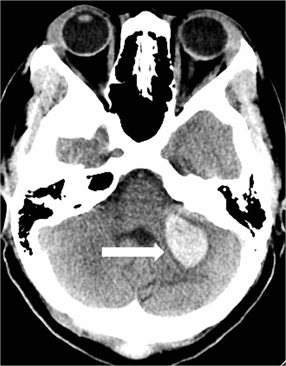 Initial-head-computed-tomography-reveals-an-acute-intraparenchymal-hemorrhage-in-the-left-cerebellar-hemisphere-(arrow).