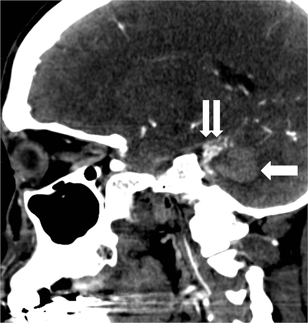 Sagittal-reconstruction-image-from-a-computed-tomography-angiogram-demonstrates-the-cerebellar-parenchymal-hematoma-(arrow)-and-the-adjacent-arteriovenous-malformation-(double-arrow).
