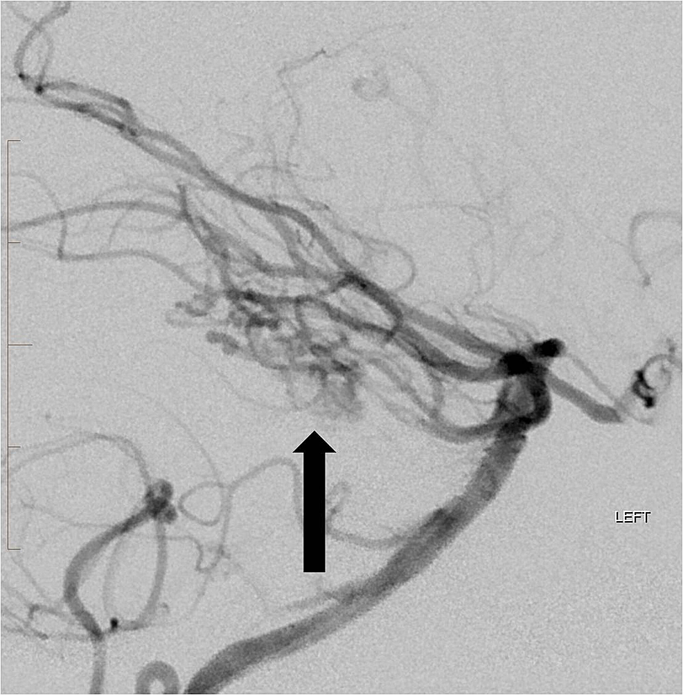 Following-embolization-of-the-superior-cerebellar-and-anterior-inferior-cerebellar-artery-branches-to-the-arteriovenous-malformation,-there-has-been-marked-reduction-in-the-size-and-flow-dynamics-of-the-arteriovenous-malformation-nidus-(arrow).