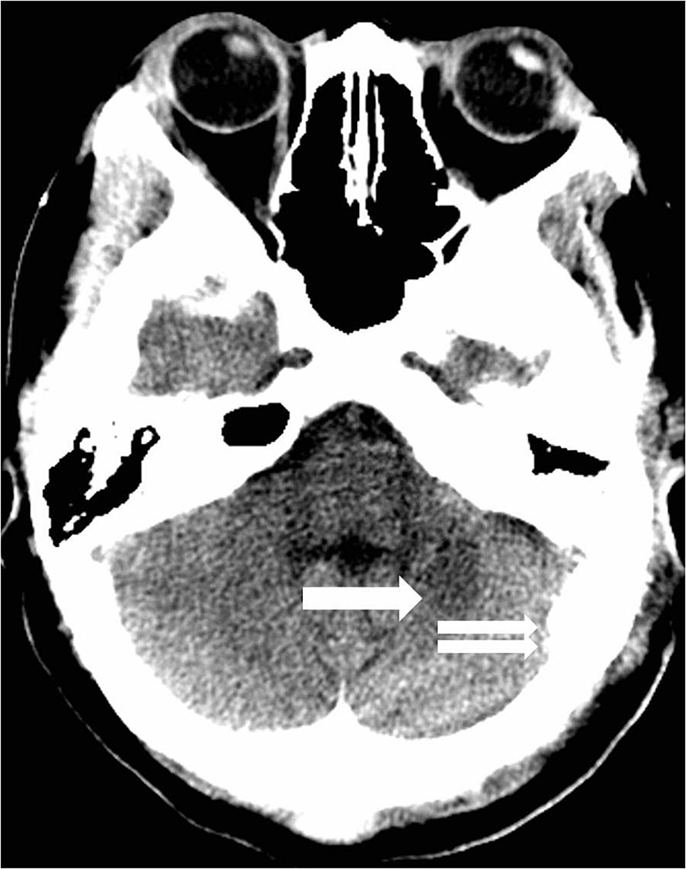 Postoperative-head-computed-tomography-two-weeks-after-surgery-reveals-a-focal-area-of-encephalomalacia-where-the-hematoma-used-to-reside-(arrow).-Subtle-changes-from-a-left-retromastoid-craniotomy-are-evident-(double-arrow).