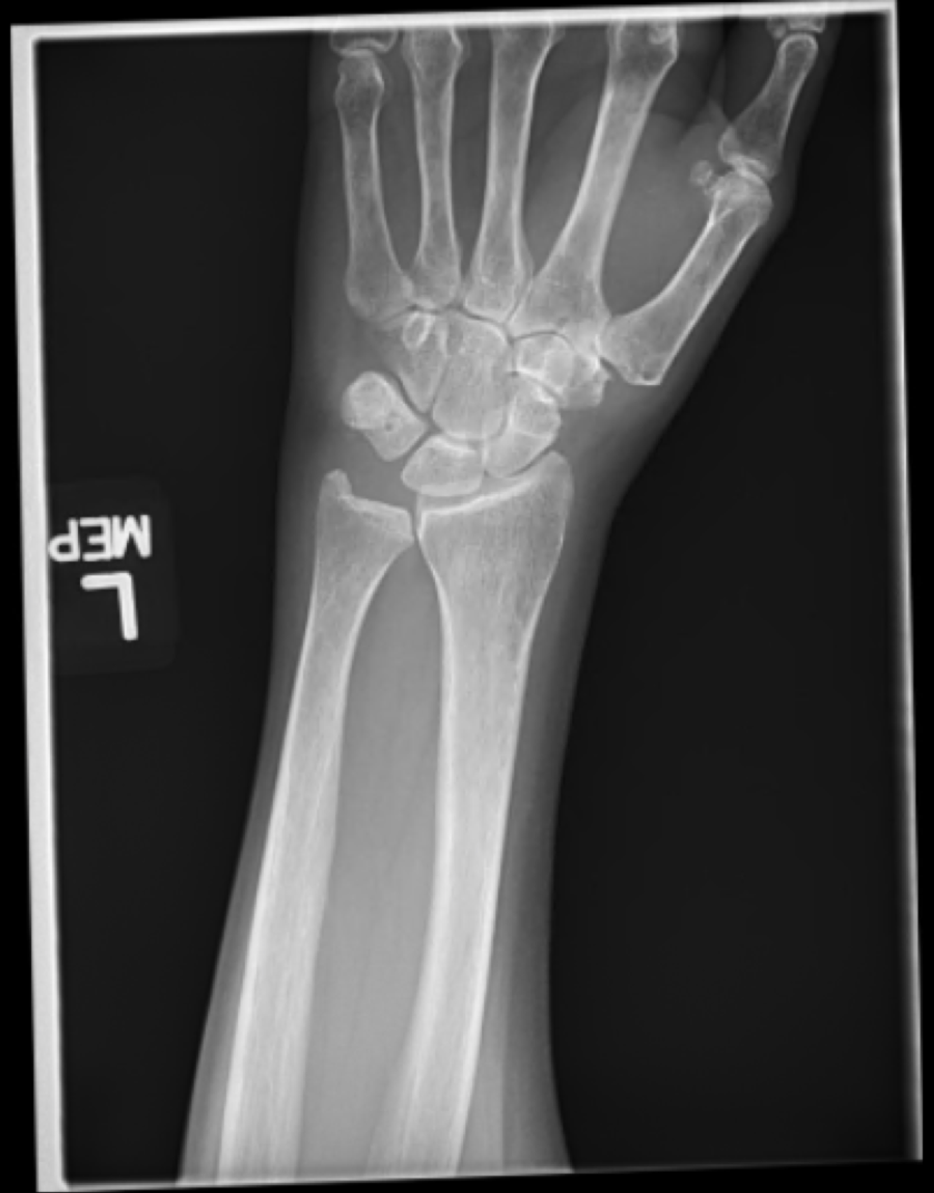 Lateral Wrist X Ray Labeled - vrogue.co