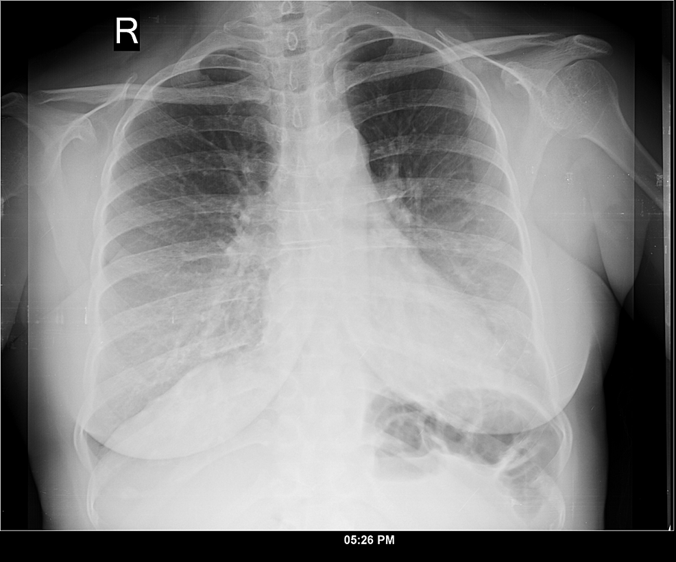 Chest-X-ray-posteroanterior-view:-taken-three-years-after-the-surgery