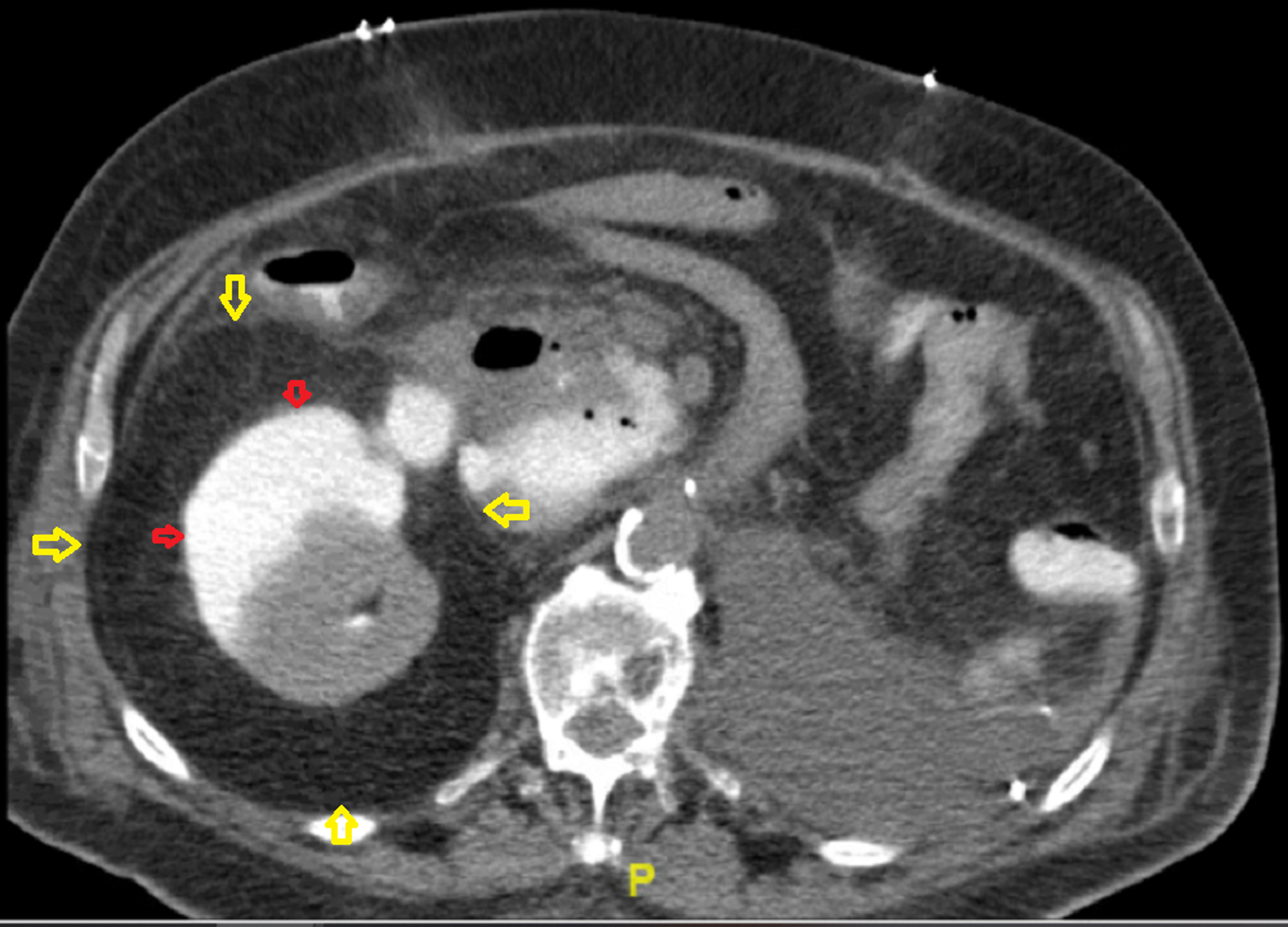 Cureus Page Kidney From a Subcapsular Urinoma Following Contralateral