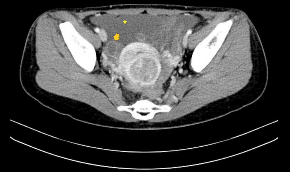 Abdominal-CT-scan-–-axial-view-showing-massive-ascites-(asterisk),-right-adnexal-mass-(arrow),-and-soft-tissue-seeding