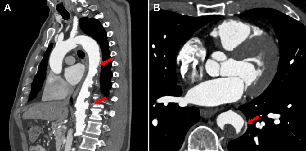 Blue Toe Syndrome and Acute Kidney Injury Following Transcatheter Aortic Valve Replacement: A Biopsy-Proven Case of Cholesterol Embolization Syndrome