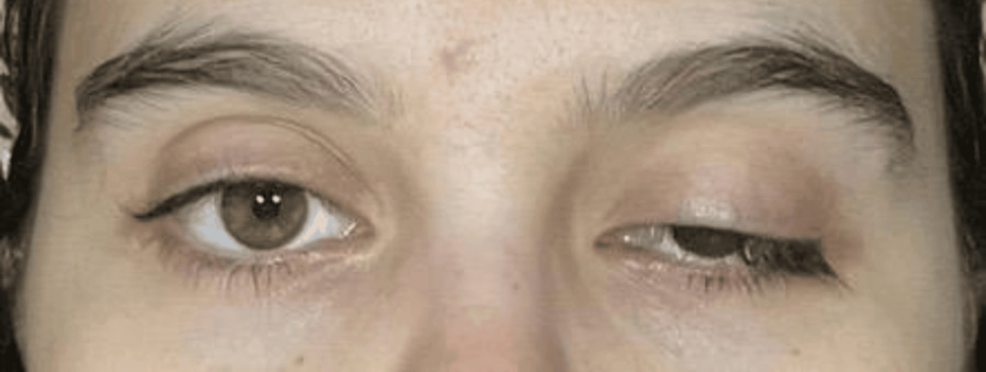 Left-sided-ptosis-during-symptomatic-presentation-at-the-Emergency-Department.-The-photograph-demonstrates-unilateral-left-up