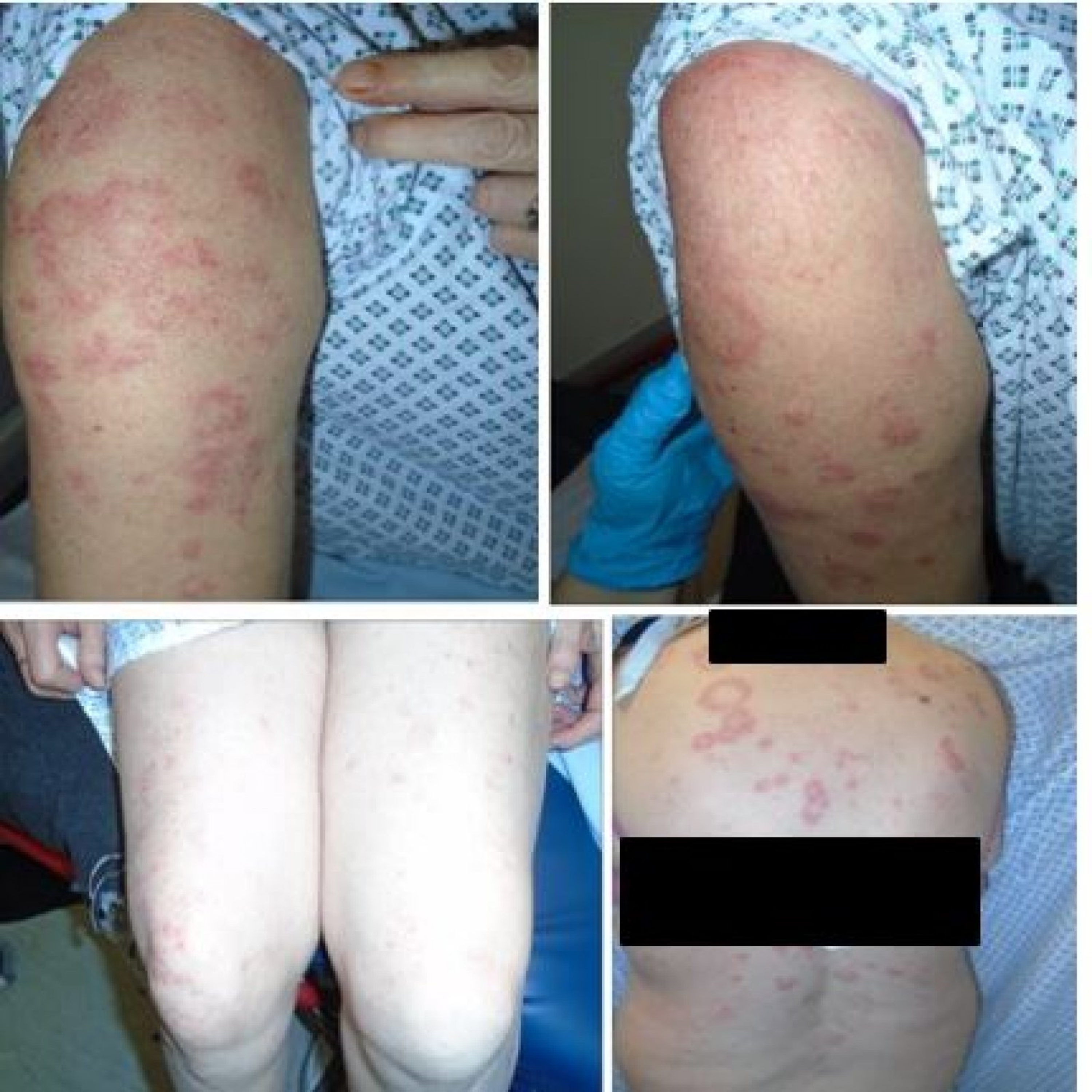 Cureus Covid 19 Vaccination Induced Rash Does The Choice Of Vaccine Matter