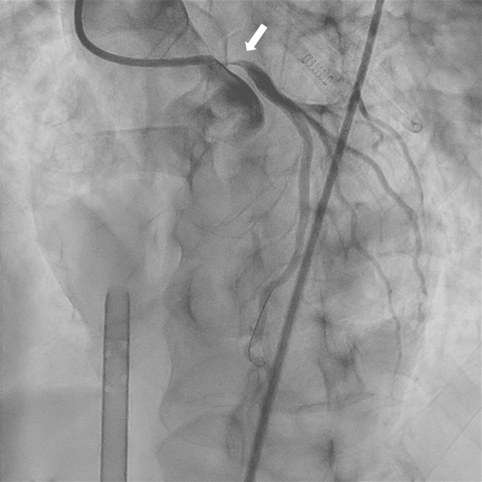 Suspected Syphilitic Left Main Coronary Stenosis Case Report