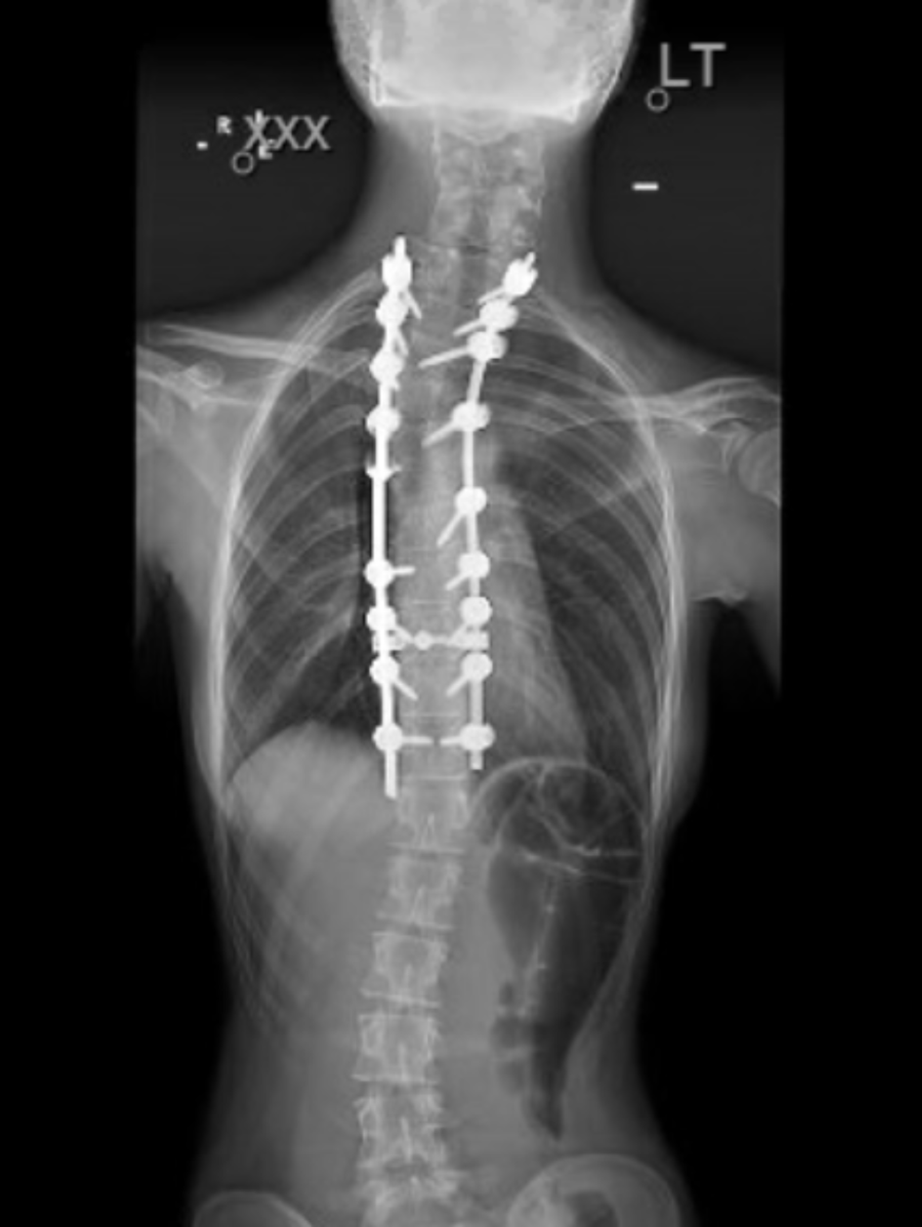 Cureus Sprengel’s Deformity With Congenital Scoliosis Successfully