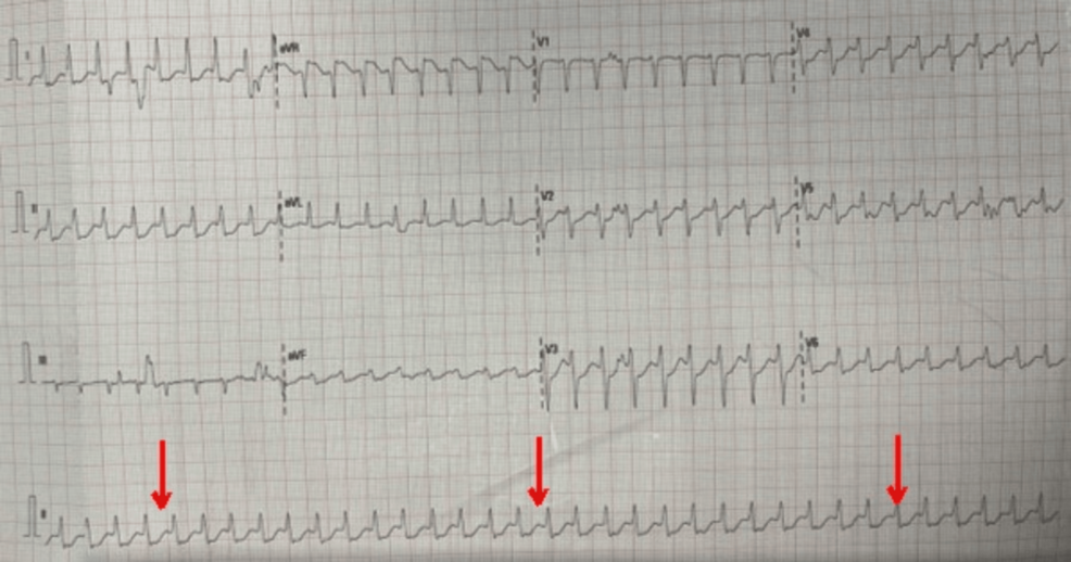 Patient develops persistent supraventricular tachycardia after CVC insertion