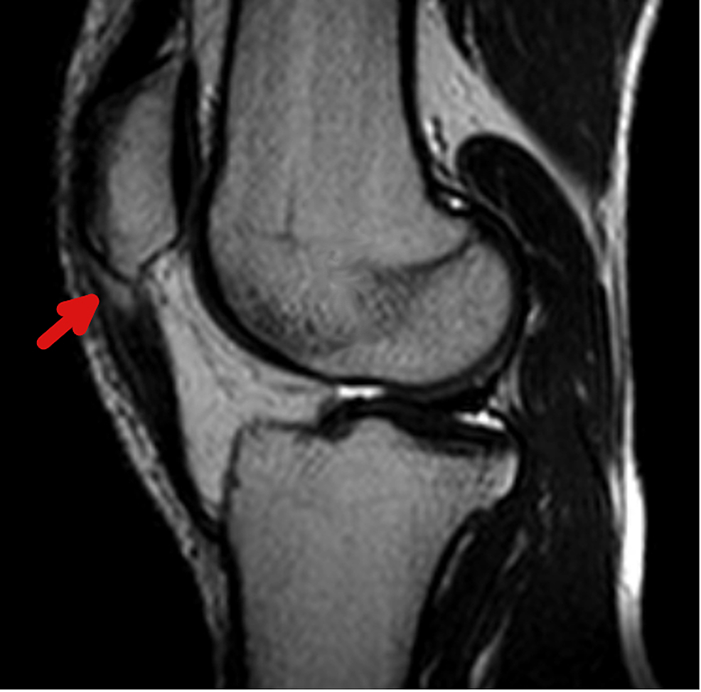 Bioinductive Collagen Implant Augmentation for the Repair of Chronic ...