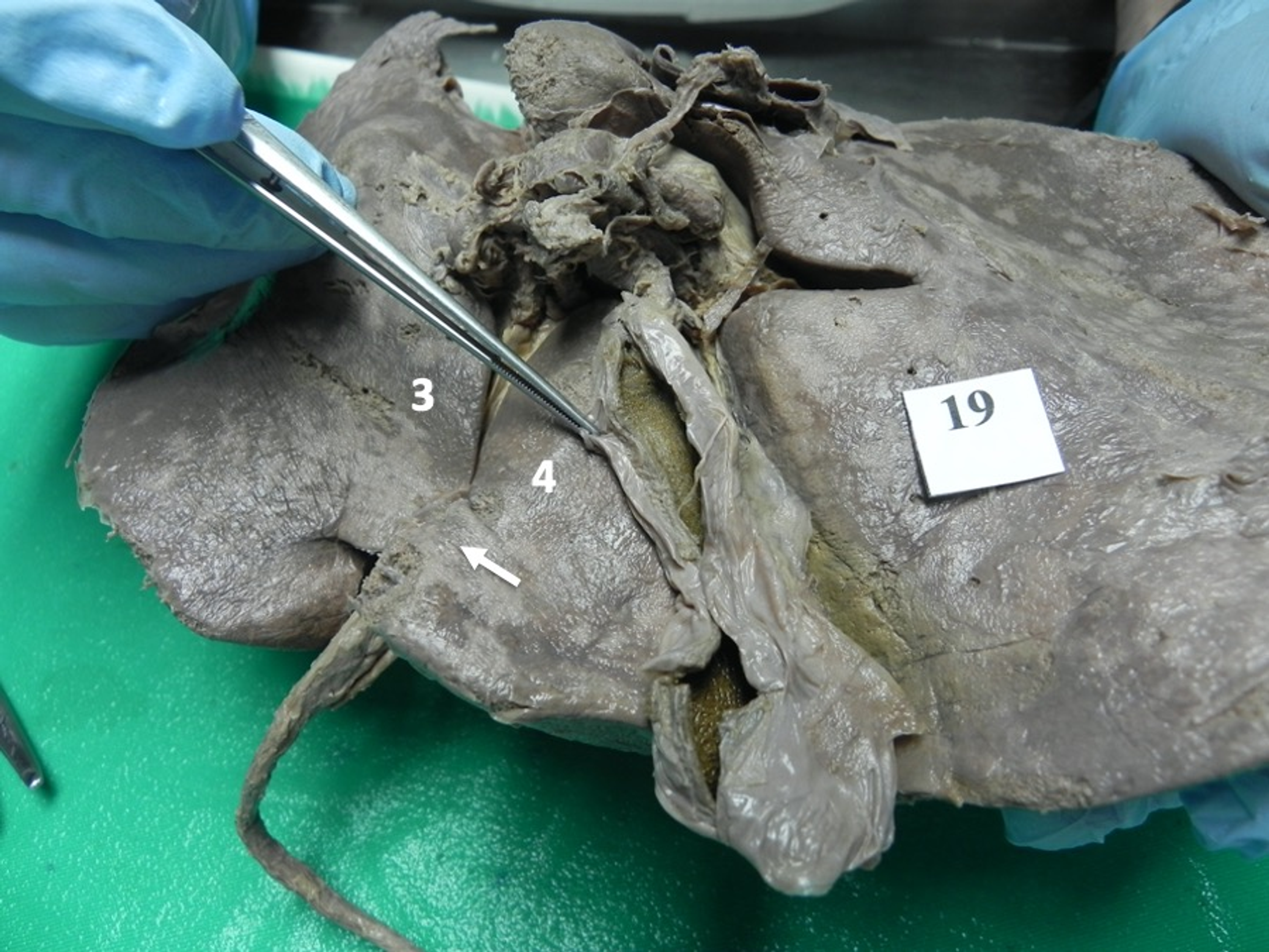 Cureus Clinically Oriented Classification Of Anatomic Variants Of The Umbilical Fissure For Ligamentum Teres In The Human Liver