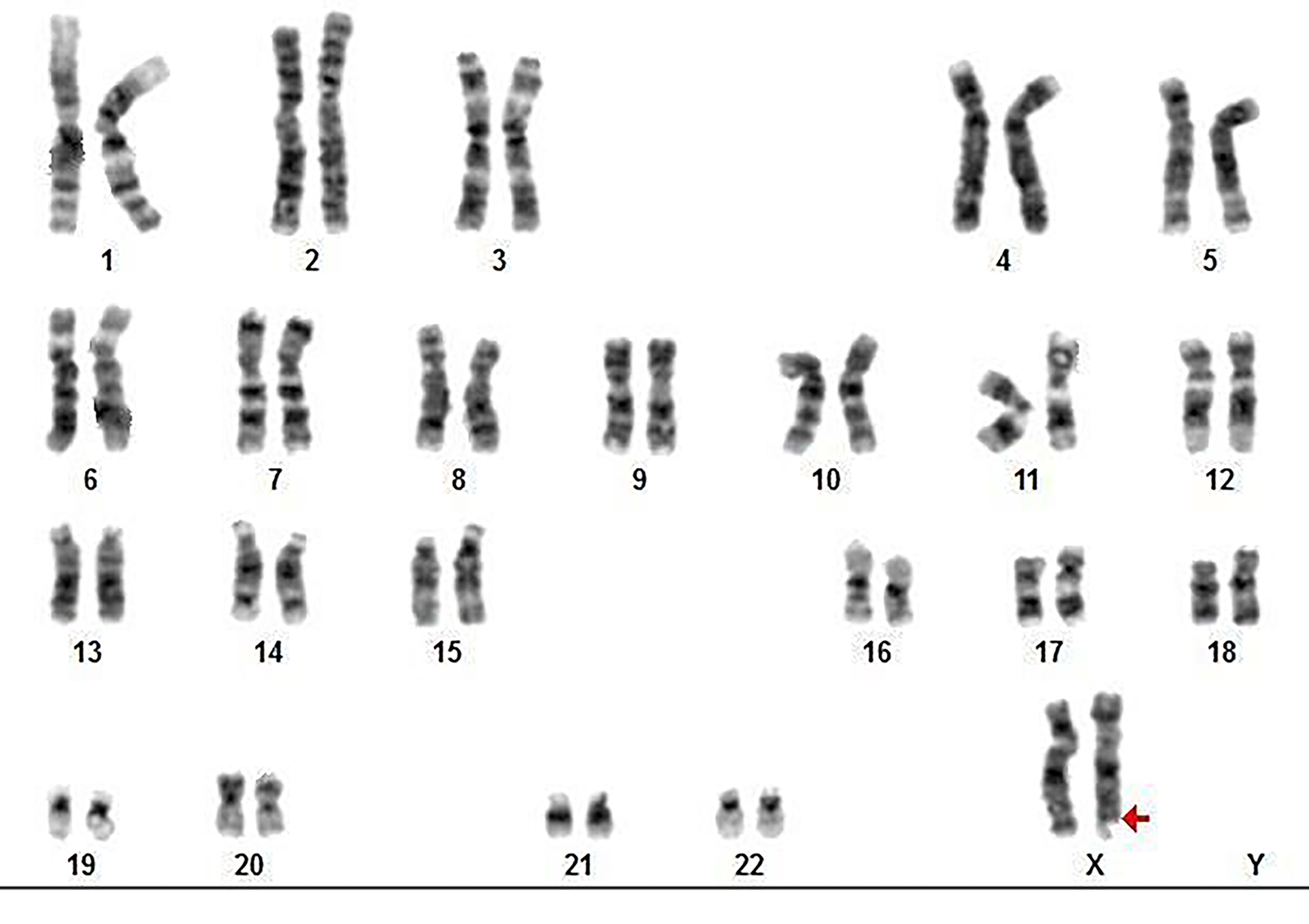 fragile x syndrome karyotype