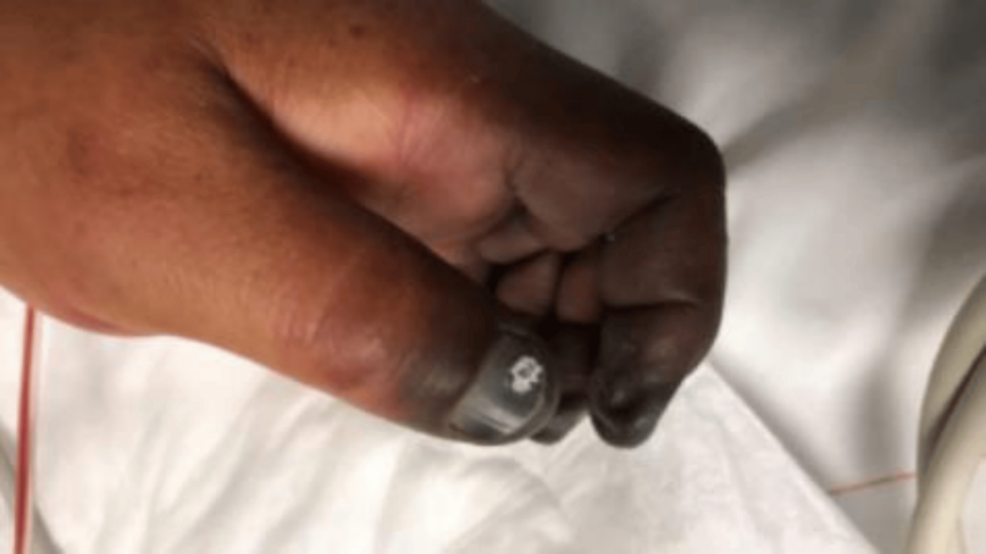 Distal-ischemic-changes-of-the-upper-extremity-at-intensive-care-unit-admission.-Progressive-cyanosis-and-dry-gangrene-involv