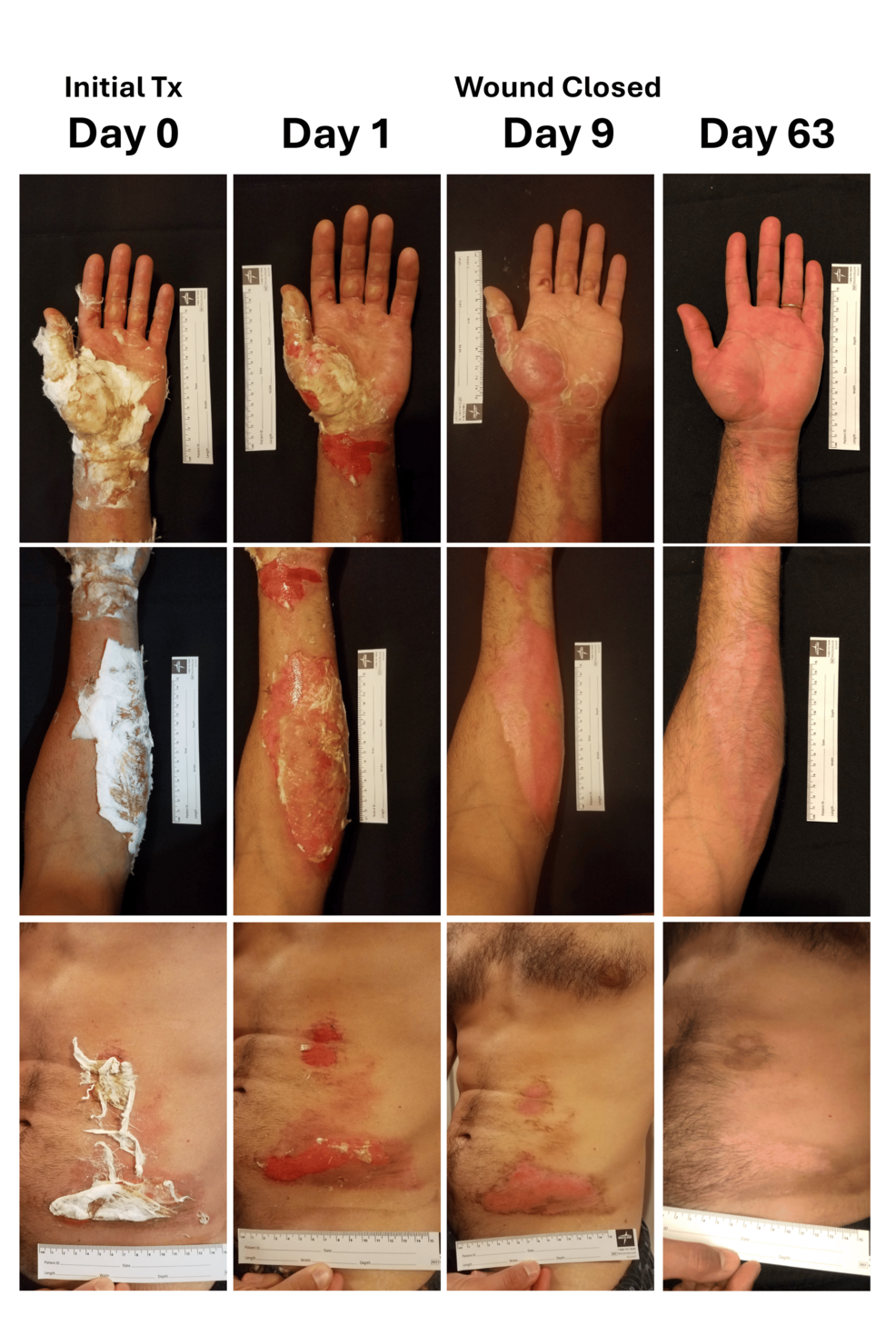 Rapid Pain Reduction and Wound Closure Following Treatment With an