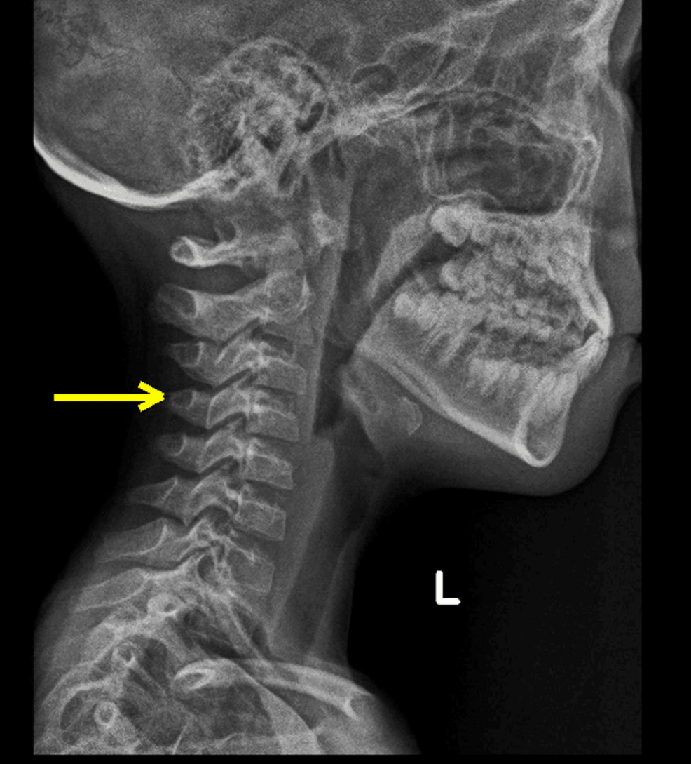 Relief of Pediatric Migraine and Abdominal Pain with Upper Cervical Chiropractic Care
