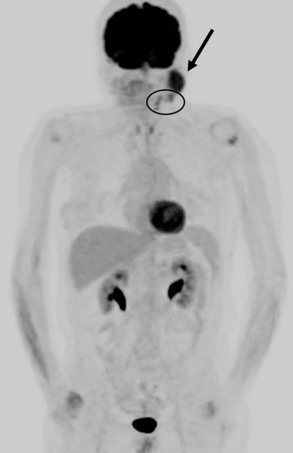 Cureus A Primary Parotid MucosaAssociated Lymphoid Tissue Non