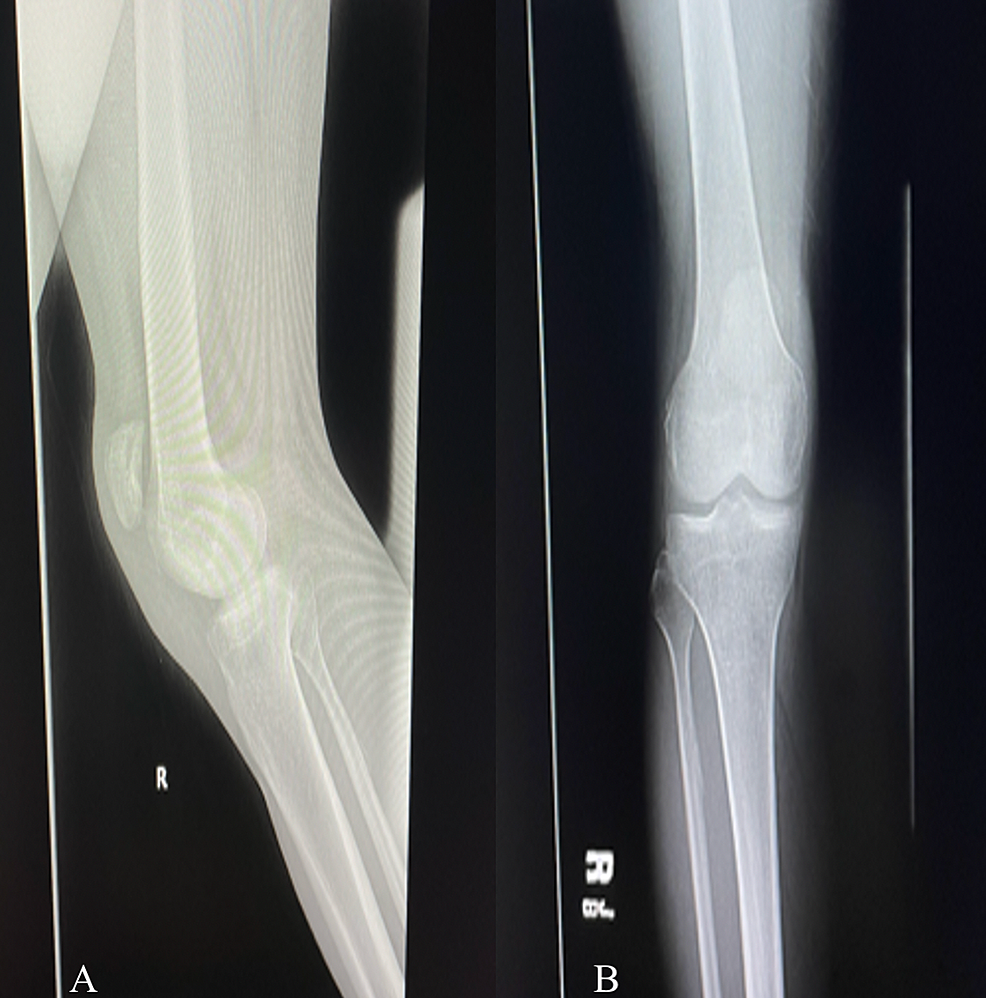 Simultaneous Bilateral Patellar Tendon Rupture In A Patient With ...