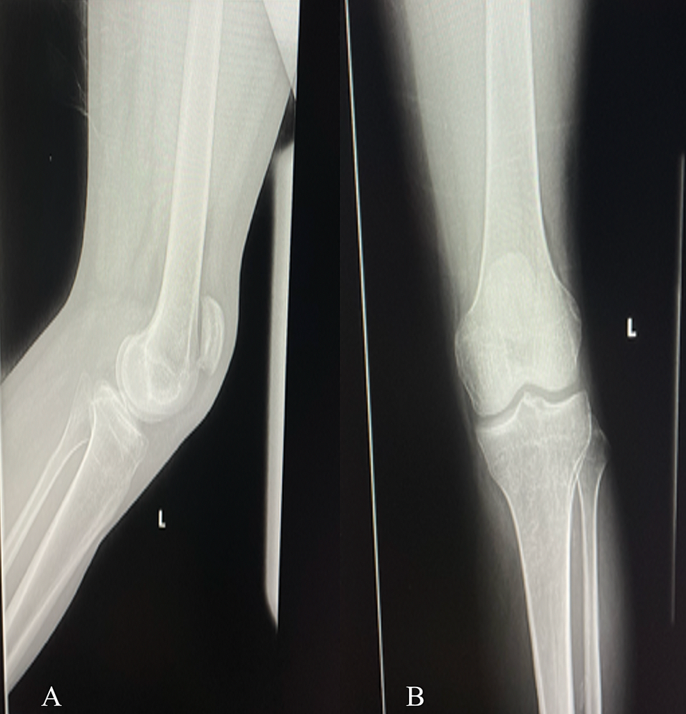 Cureus | Simultaneous Bilateral Patellar Tendon Rupture In A Patient ...