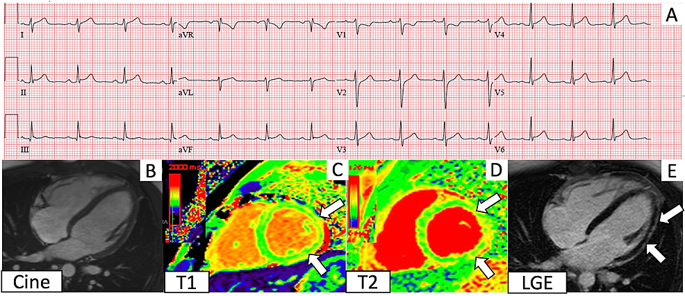 Electrocardiogram-(ECG)-and-cardiac-magnetic-resonance-imaging-(CMR)-findings-corresponding-to-Case-2