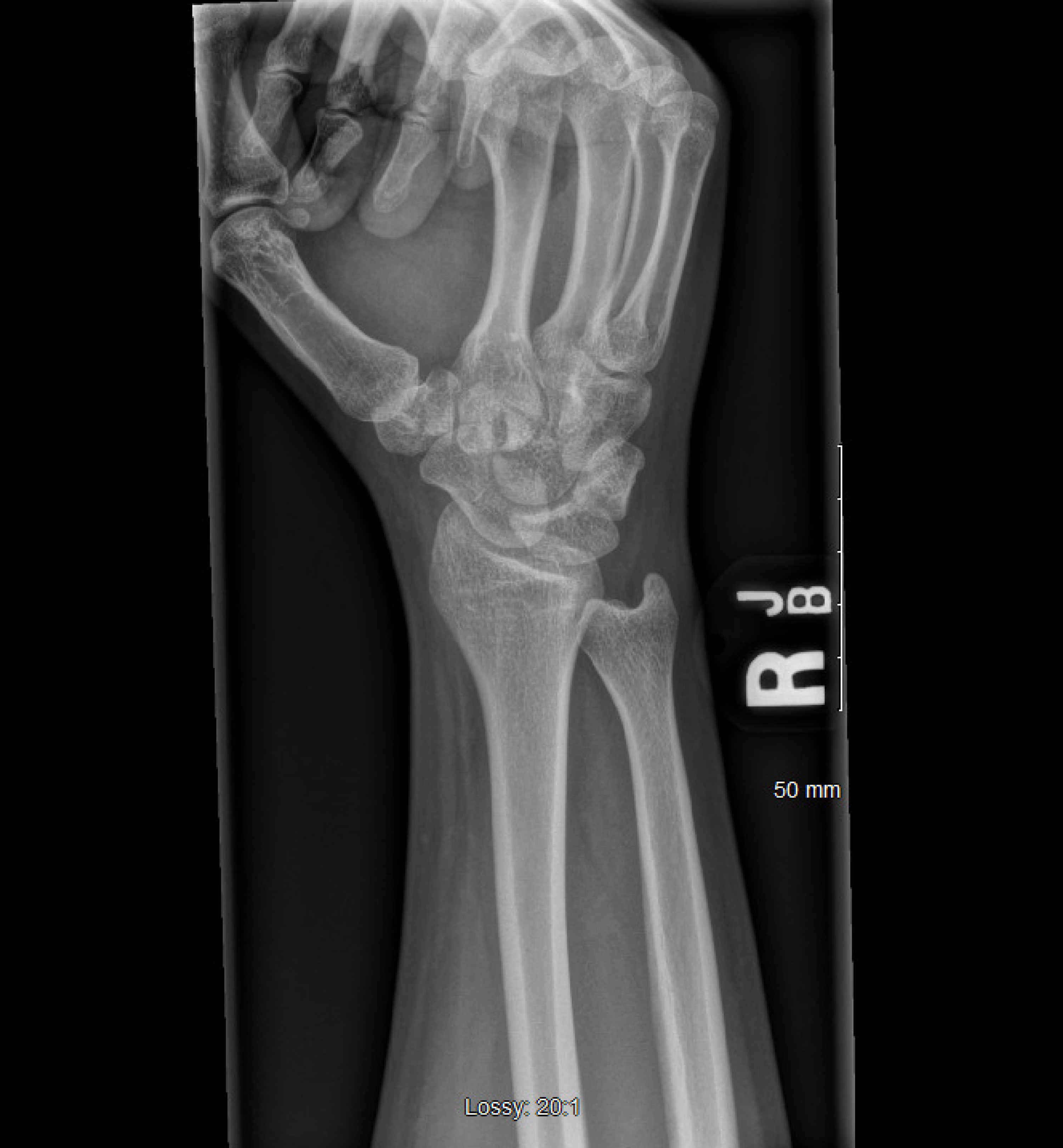 Cureus Carpal Tunnel Syndrome Secondary to Fibrolipomatous Hamartoma