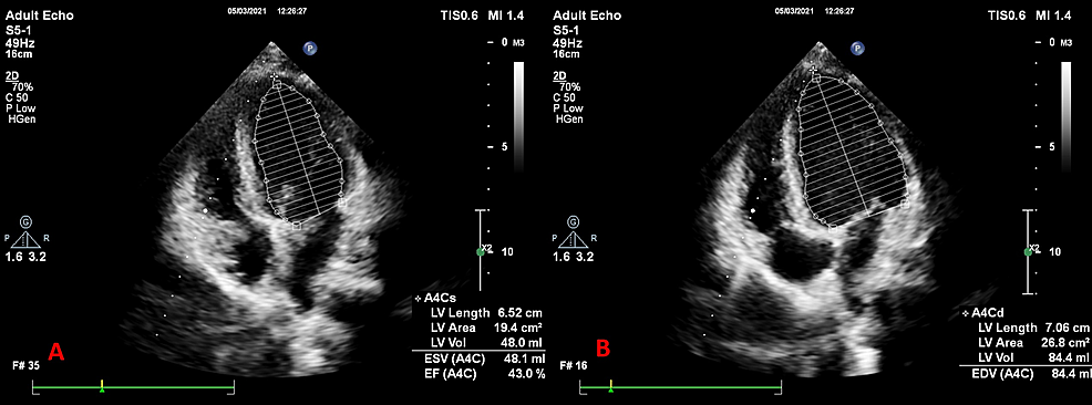 Echocardiography findings. Echocardiography shows global hypokinesia on