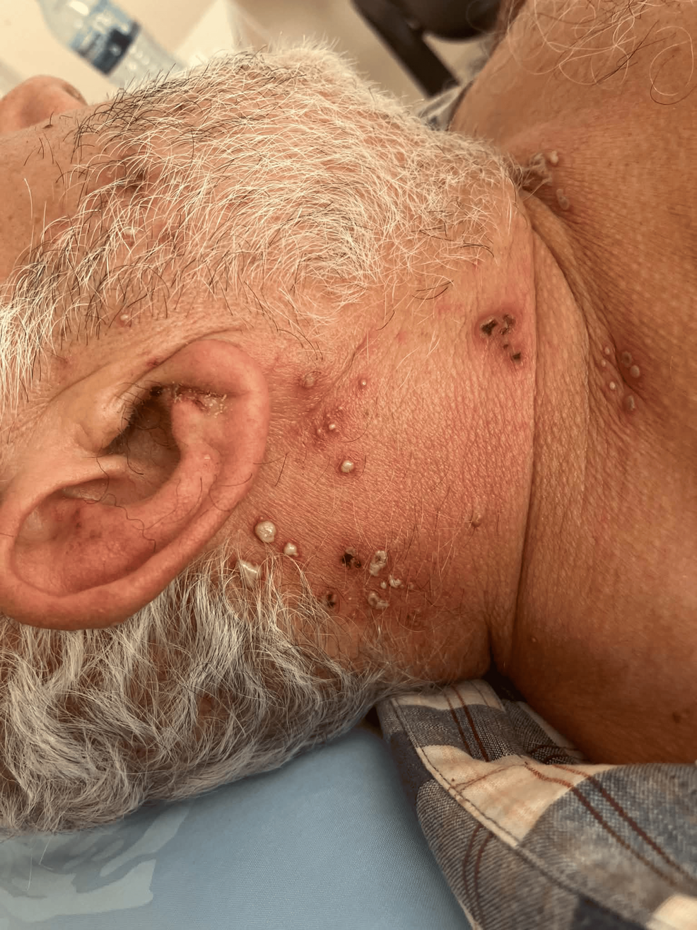Polymorphic-vesicular-and-crusted-eruption-involving-the-right-preauricular-area,-scalp,-neck,-and-anterior-chest