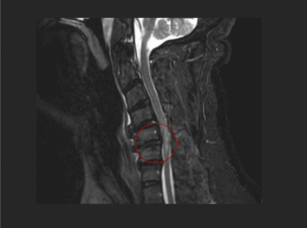 Guillain-Barré Syndrome in a Patient With Cervical Myelopathy and Lumbar Spinal Stenosis Following a Fall: A Diagnostic Challenge - Cureus