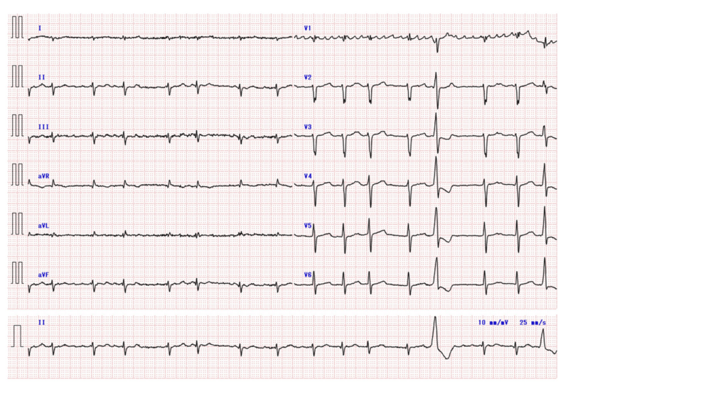 Patient Develops QT Prolongation and Torsades de Pointes After Pulsed Field Ablation