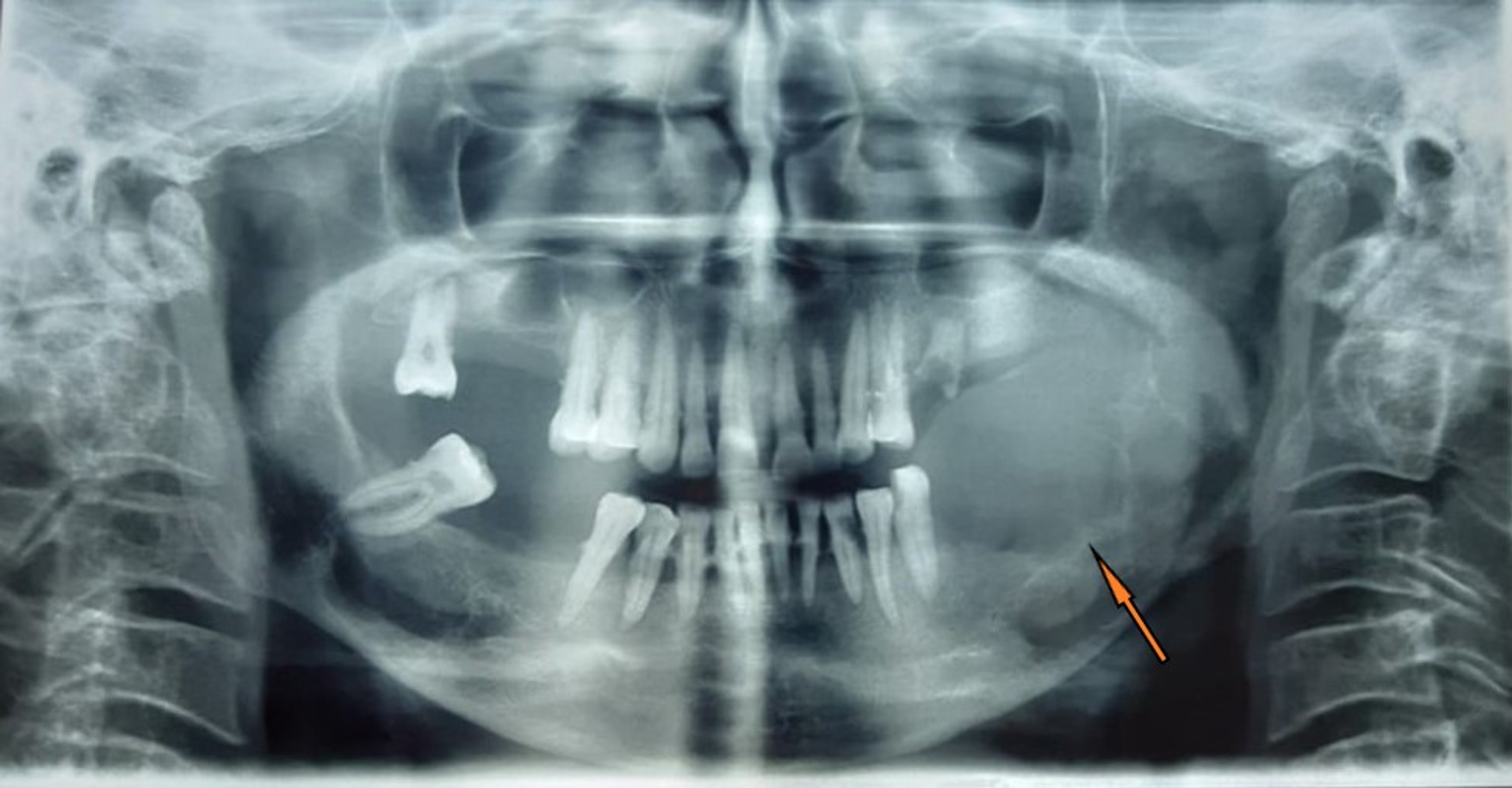 Cureus An Aggressive Central Giant Cell Granuloma of Mandible in an