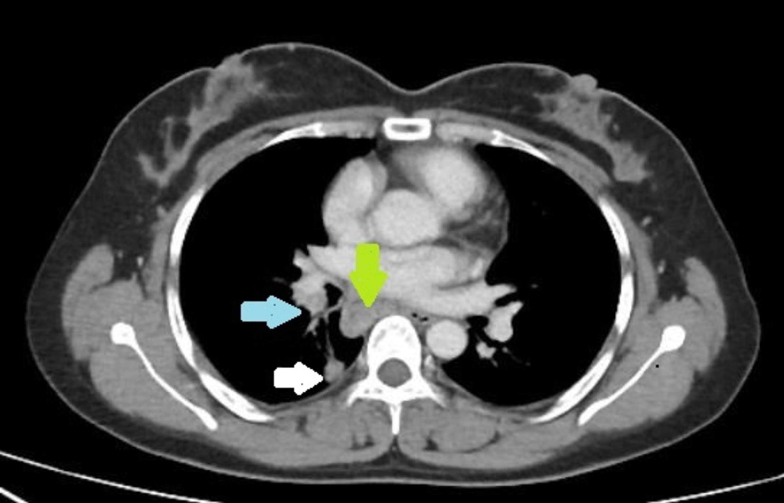 Cureus The Clinicopathological Features of Mediastinal Tuberculous